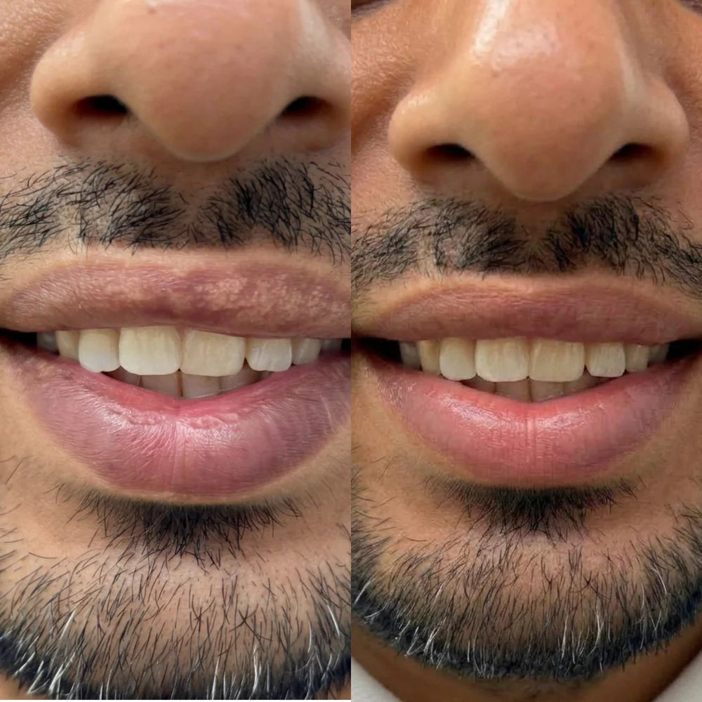 Nexisify® Fordyce Cream for Lips