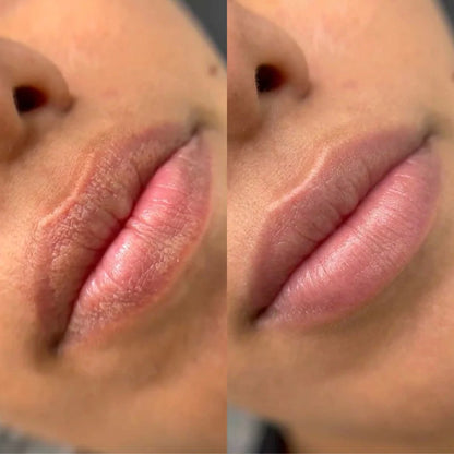Nexisify® Fordyce Cream for Lips