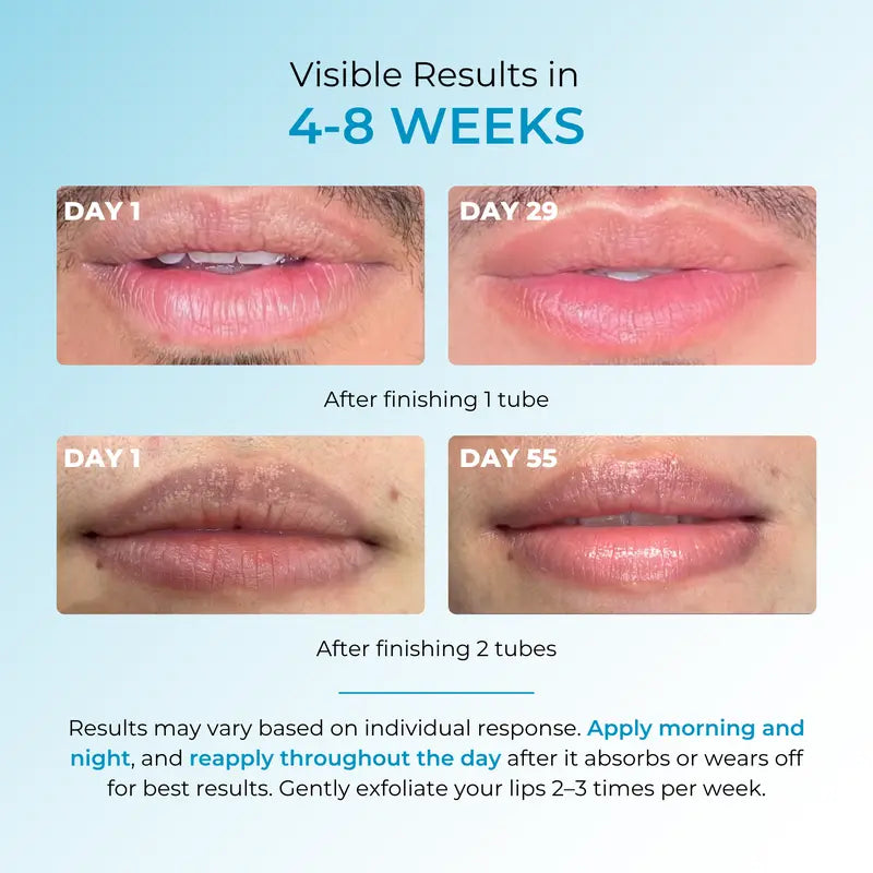 Nexisify® Fordyce Cream for Lips