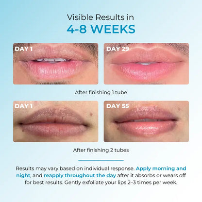 Nexisify® Fordyce Cream for Lips